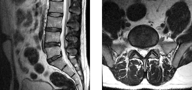 MRI shows healing